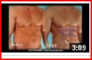 Houston Texas Abdominal Etching Cosmetic surgery Liposuction Facelift Breast Augmentation